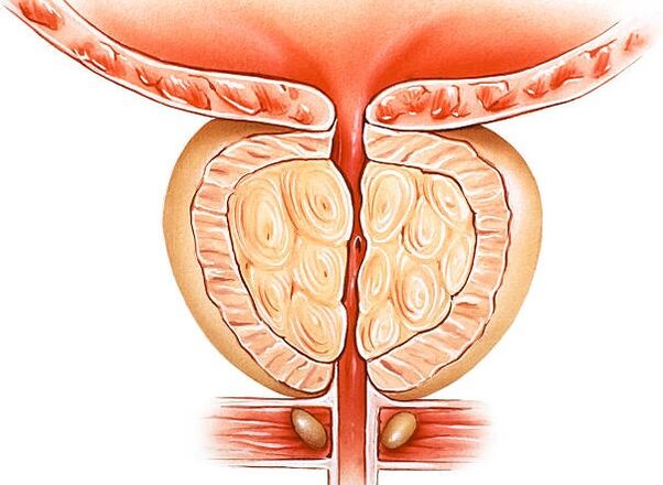 illustration of an inflamed prostate