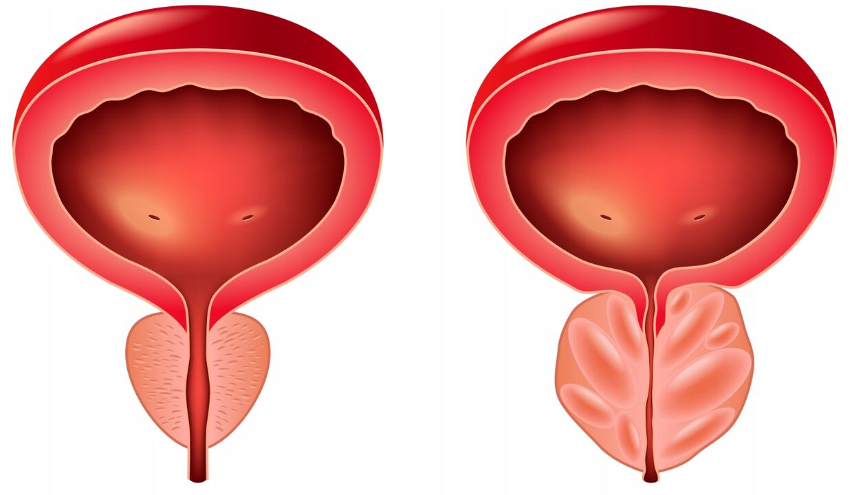 difference between the prostate gland